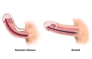 penis problem, peyronies disease, penis being curved, curved penis, straight penis, my penis is curved, penis is not straight